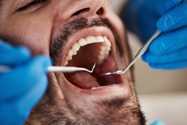 Best Emergency Tooth Extraction in Palmer, TX